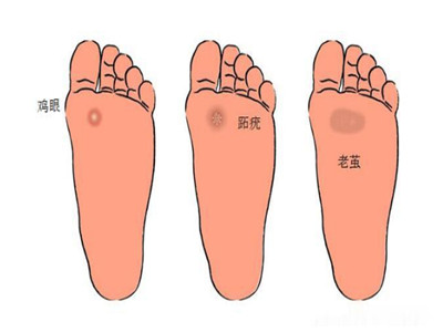 简简单单治好跖疣只需一个小方法