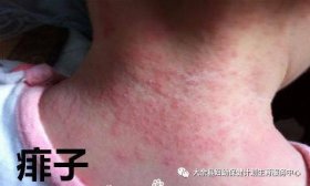 脸上长了密密麻麻像痱子一样图片