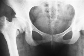 骨盆修复仪做完10次有效果吗